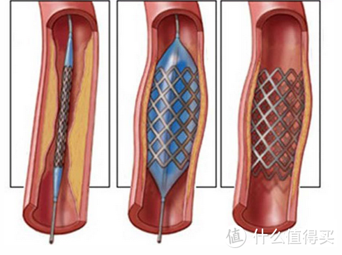 避雷保：心脏支架价格大跳水，保险还有啥用