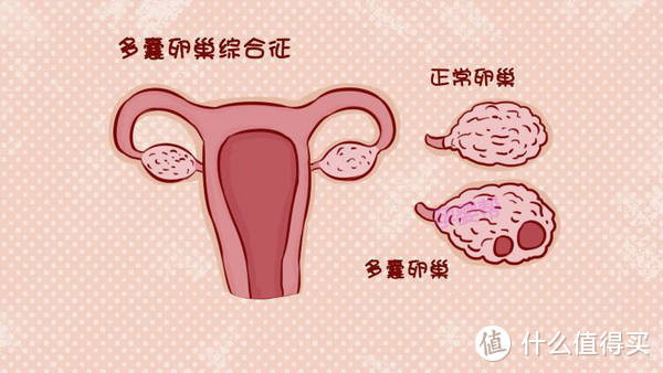 卵巢多囊样改变是怎么回事？会不会影响怀孕呢