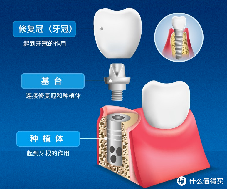 牙齿缺了一颗，要不要补？种植牙了解下