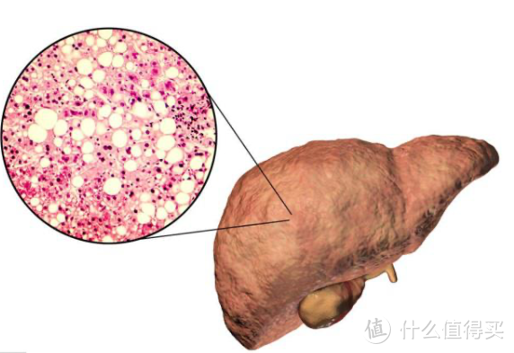 体检查出了脂肪肝、肝囊肿……我愣是扒明白了肝脏相关体检指标