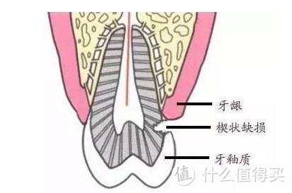 楔状缺损示意图