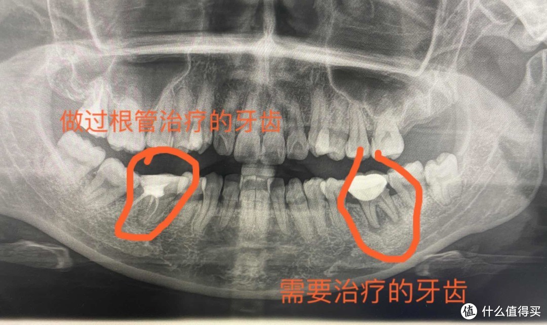 同一颗牙，我居然做了两次“根管治疗”。这个坑大家千万别踩！