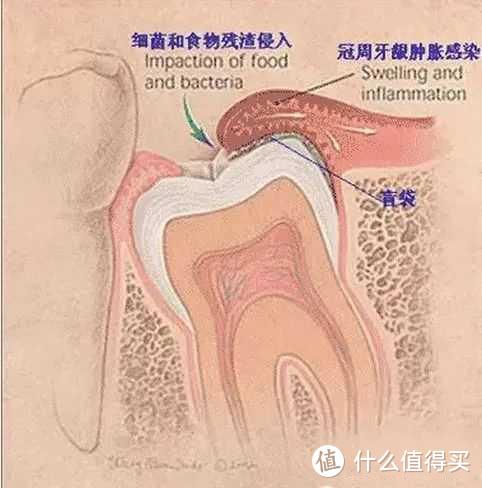 智齿形成的盲袋