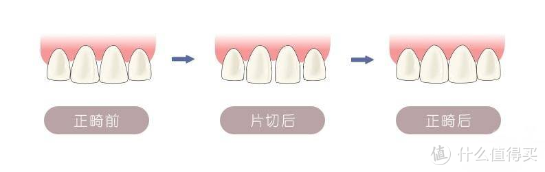 矫正之拔牙篇——拔牙“三连问”：一定要先拔智齿再矫正吗？