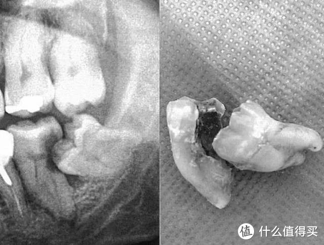 拔一送一！智齿大力出奇迹将前牙干废