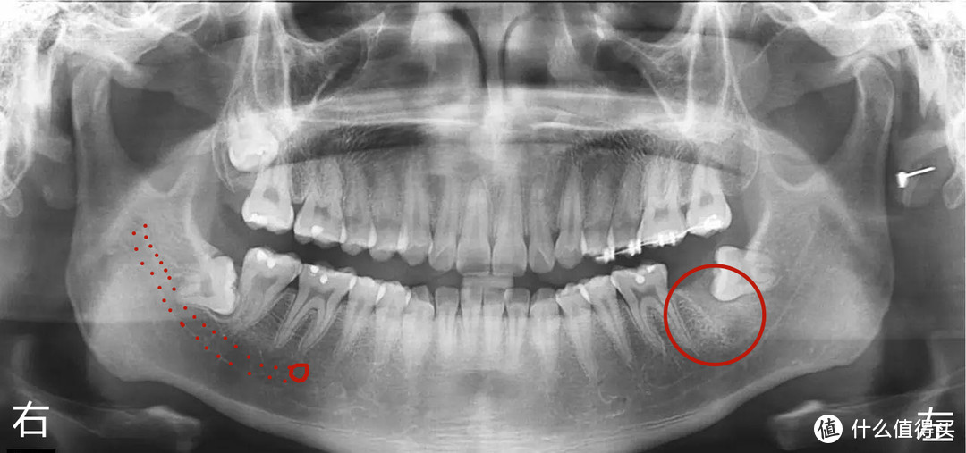 智齿有问题，至少拍个曲面断层片，最好拍口腔三维CT