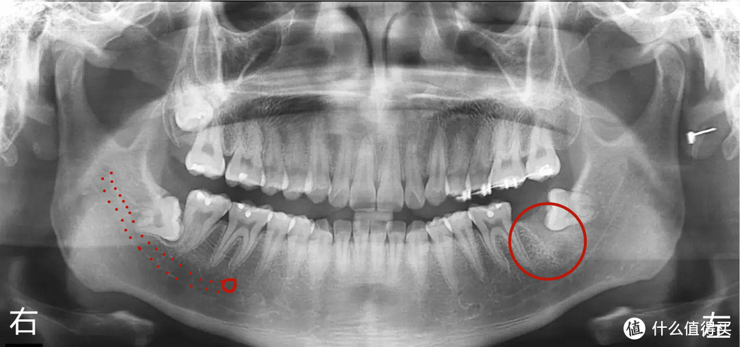 口腔科普篇四 有关智齿的33个问题 番外一 口腔健康 什么值得买