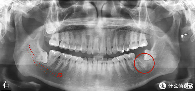 智齿有问题,至少拍个曲面断层片,最好拍口腔三维ct