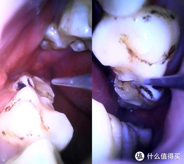 新一代口腔清洁神器 素诺智能可视超声波洁牙仪T11Pro评测