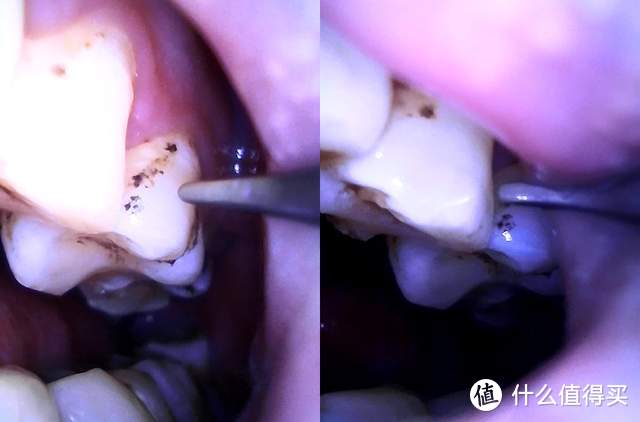 新一代口腔清洁神器 素诺智能可视超声波洁牙仪T11Pro评测