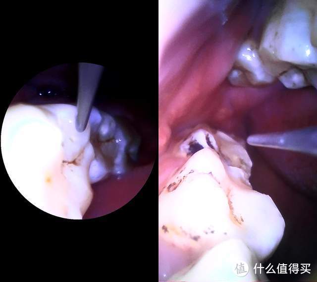 新一代口腔清洁神器 素诺智能可视超声波洁牙仪T11Pro评测