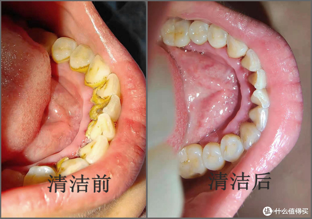 素诺超声波洁牙仪T11Pro评测：全程可视，智能护龈