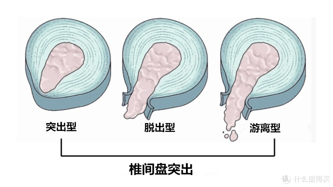 有了腰椎间盘突出，还能做硬拉吗？掌握科学的方法，视情况而定