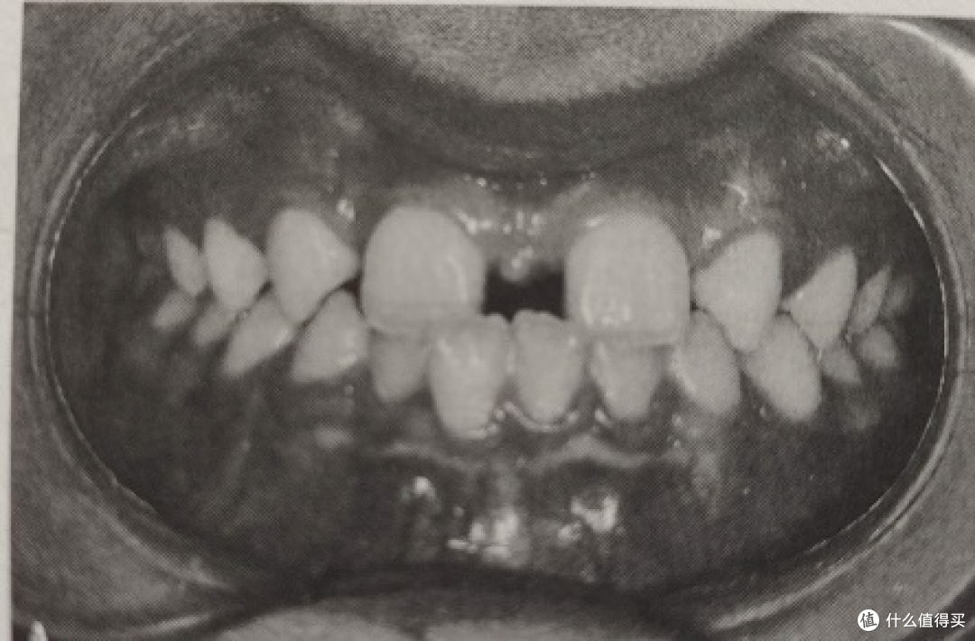 笑研所科普 天生就少了颗牙齿一定要正畸吗 健康服务 什么值得买