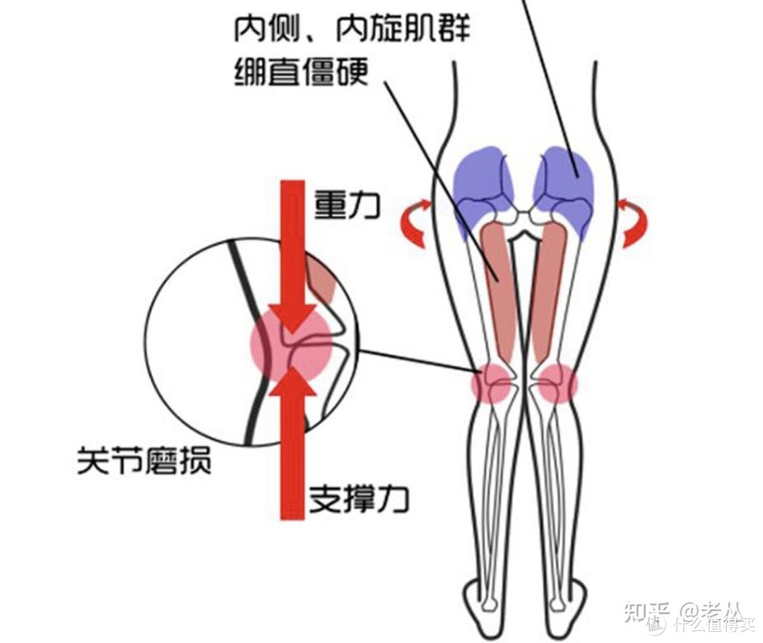 X型腿改善攻略｜先学会自查再自纠！简单易操作的6个改善动作！