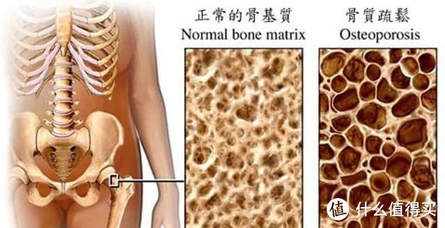 30岁还没开始补钙？！骨质疏松离你不远了！