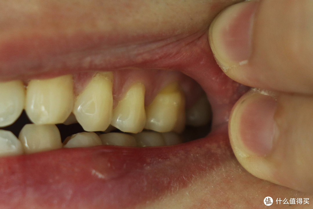 一个牙龈患者的脱敏牙膏挑选记录！请珍惜你的一口好牙