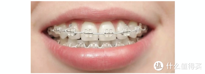 牙齿矫正怎么选牙套？各种牙套有哪些优劣势？这篇给你讲清楚