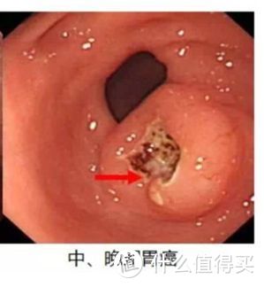 95%的体检都查不出癌症：癌症早筛是真有用，还是智商税？