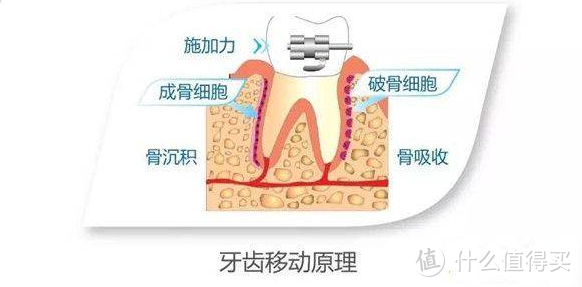 笑研所科普：矫正后坚持佩戴保持器真的很重要