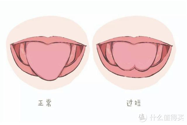  舌系帶矯正術(shù)最佳年齡_舌系帶矯正術(shù)最佳年齡12歲還能做嗎