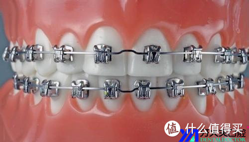 金属自锁托槽牙齿矫正器