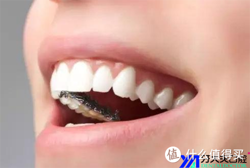 舌侧隐形牙齿矫治器