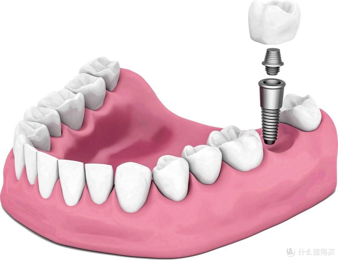 你绝不知道的种植牙内幕揭秘！三甲牙医告诉你种植牙的品牌选择与收费！