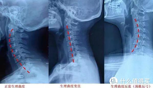 爱护好你的“后颈肉”！ 颈椎老病号护颈经验分享，4款常见颈椎按摩仪横评~ 