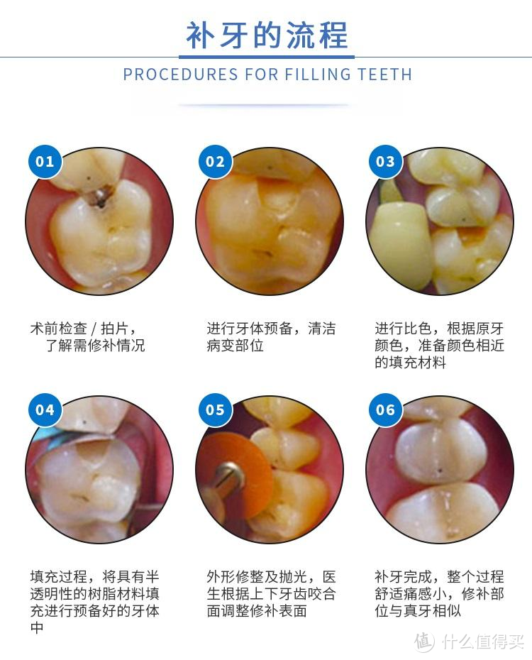 牙科有多贵？根管治疗/正畸/种牙/美白项目全面解析