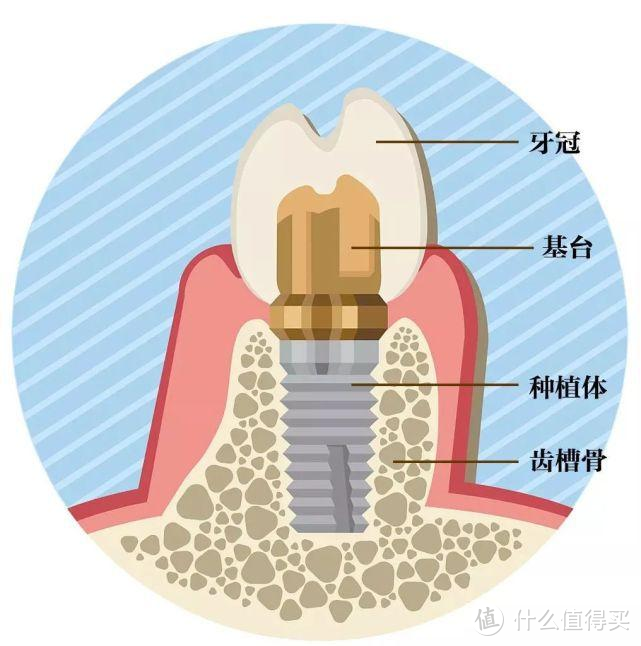 牙科有多贵？根管治疗/正畸/种牙/美白项目全面解析