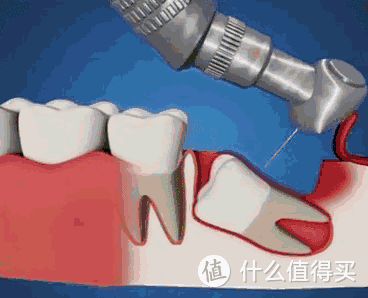 牙科“刑具”有多可怕？三分钟带你克服看牙恐惧症