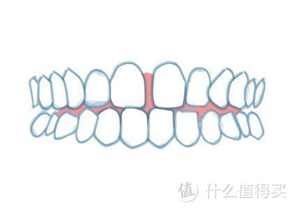 矫正科普：带你直观了解牙齿矫正适应症