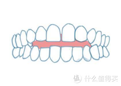 矫正科普：带你直观了解牙齿矫正适应症