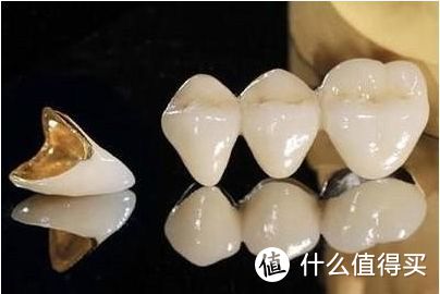 曾经一个月补4次牙的人告诉你：不同的补牙材料有哪些优缺点？