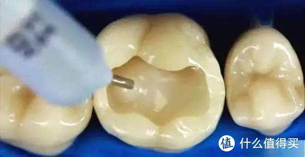曾经一个月补4次牙的人告诉你：不同的补牙材料有哪些优缺点？