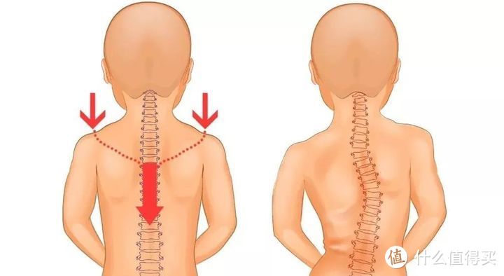上半身所有的骨骼和肌肉依然無法均勻地承受壓力,從而使脊柱側彎(嚴重