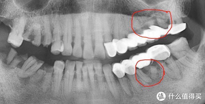 烤瓷牙能用多久？5-10年？其实不出意外的话，烤瓷牙可以熬走里面那颗真牙