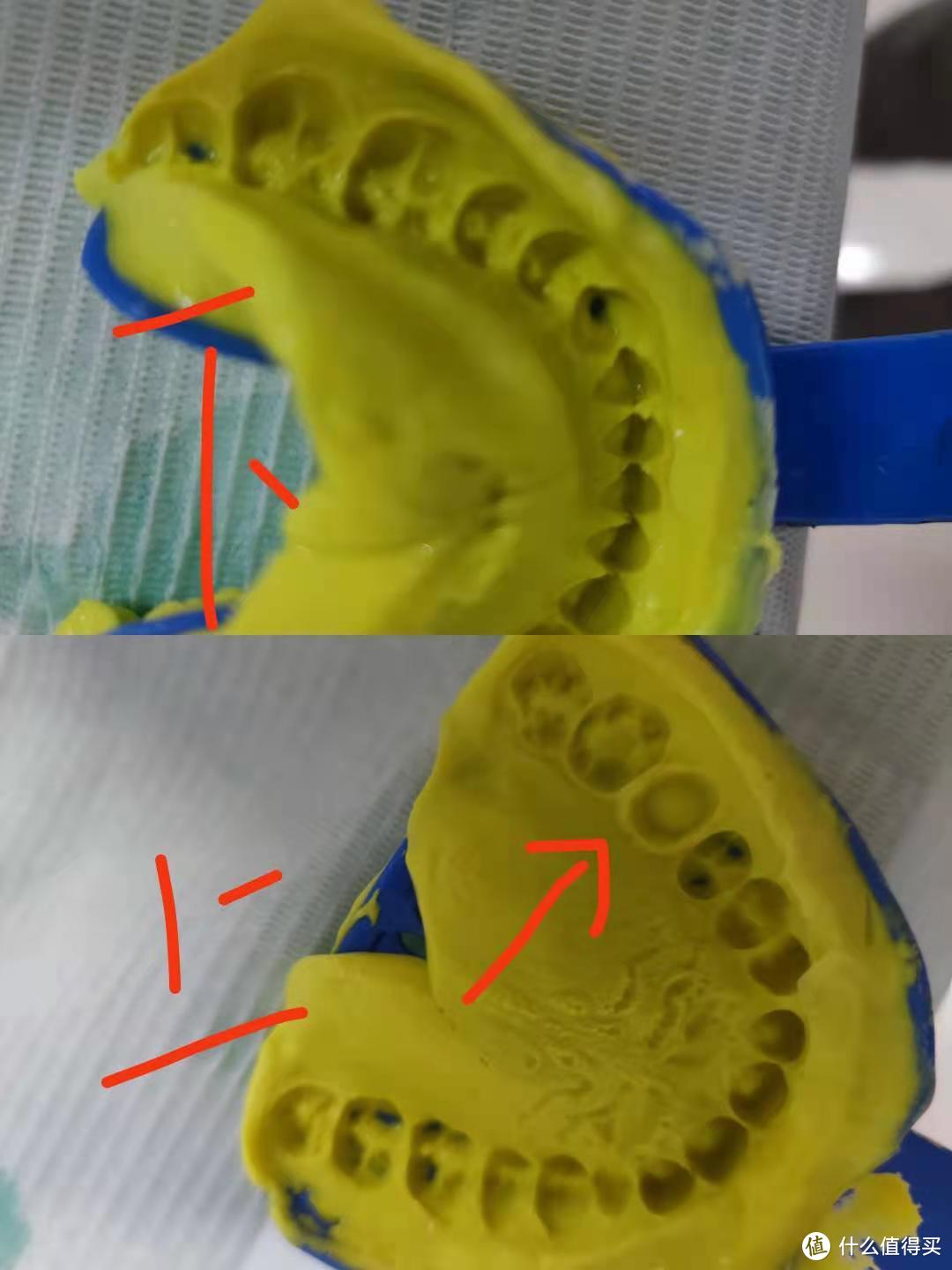 咬出来的模型，还没有灌石膏，箭头指的就是要戴牙冠的牙（已经磨小）