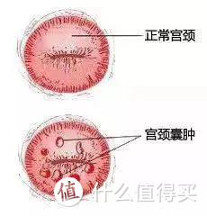 得了宫颈囊肿，还能买保险吗？