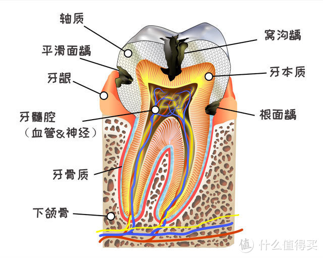 后牙上长了一条黑线是怎么回事？医生提醒：等到变成深龋就真的要命又要钱了