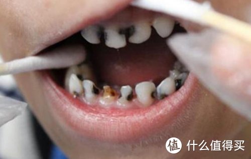儿童虫牙蛀牙龋（qu）齿有什么坏处？怎么解决？