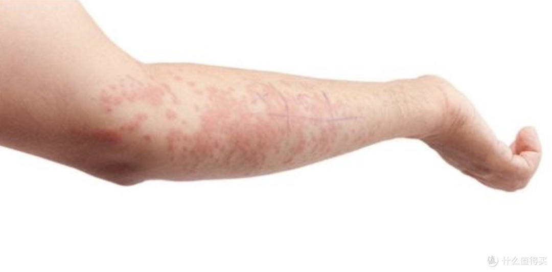 75%酒精消毒液过敏怎么办?阅紫告诉你几个防疫小妙招