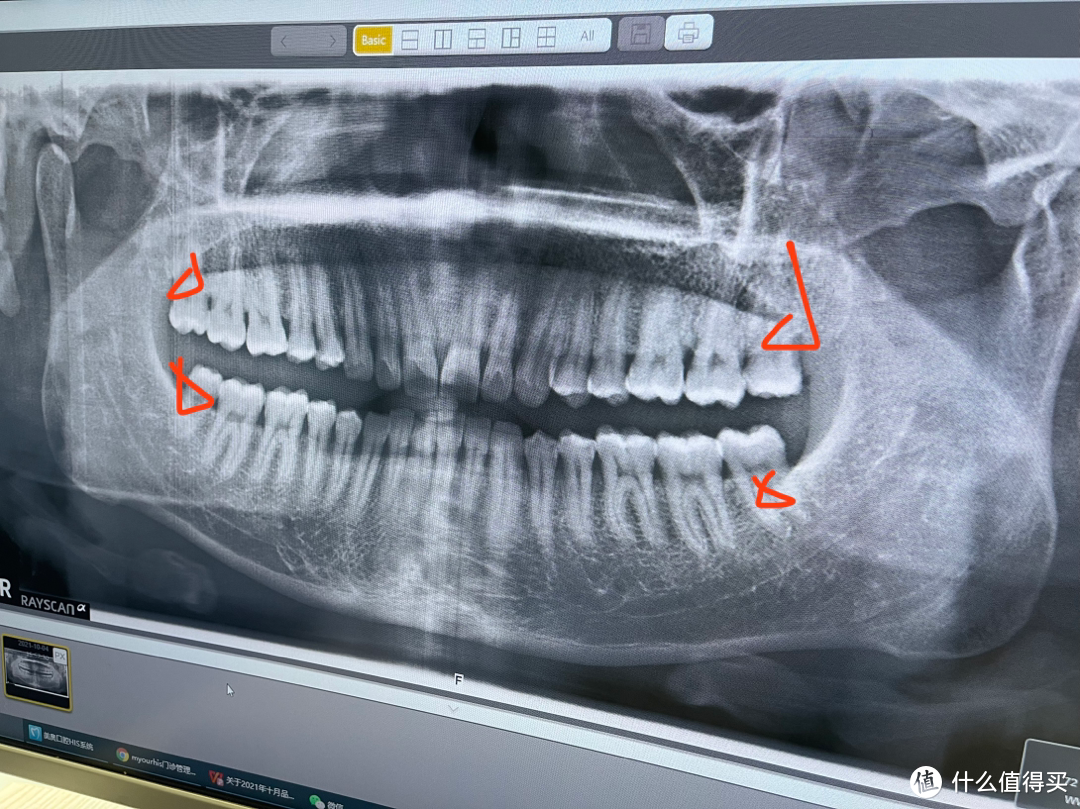 M奥口腔牙齿检查经历(牙齿锲形缺损补牙....)