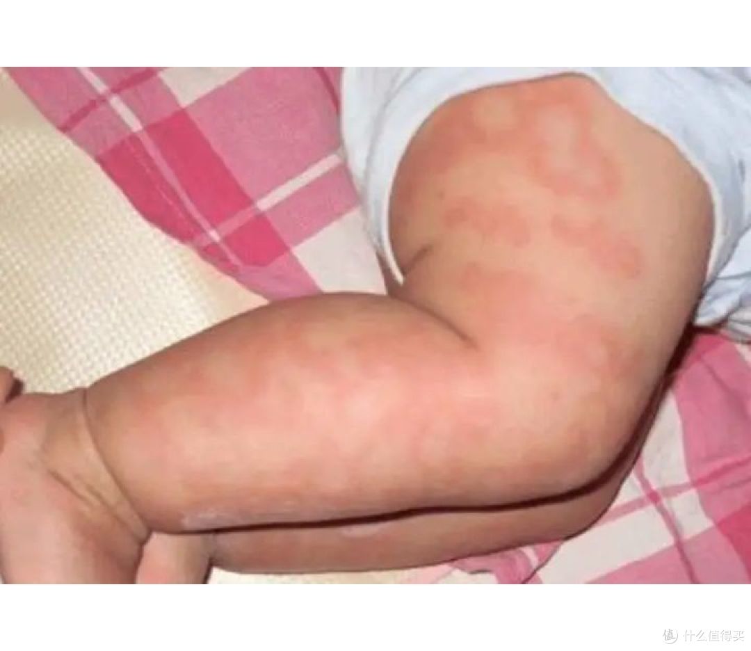 有吃什么特别的食物,也没有接触到过敏原,但宝宝身上却突然开始起红疹