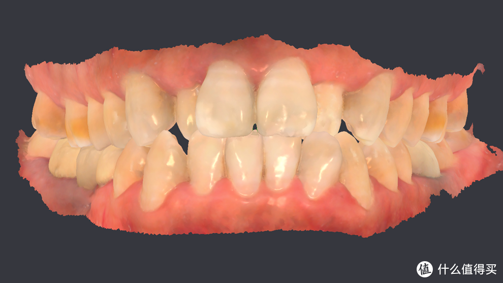 口内三维图像截图