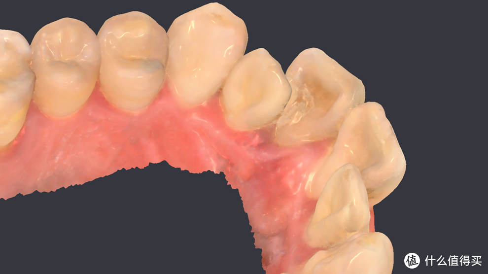 口内三维图像截图