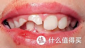 补牙3连问：意外缺牙的我是该去补牙冠，嵌牙体还是纯补牙呢？