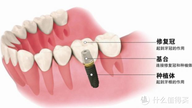 做种植牙前做好这些调研，才算对的起自己的牙“生”！