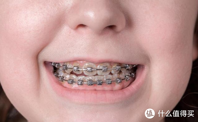 有注意孩子牙齿健康吗？不愿意花小钱护牙、就要花大钱治牙！